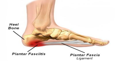 Plantar-1 - Back & Joint Rehab Center Crown Point Indiana