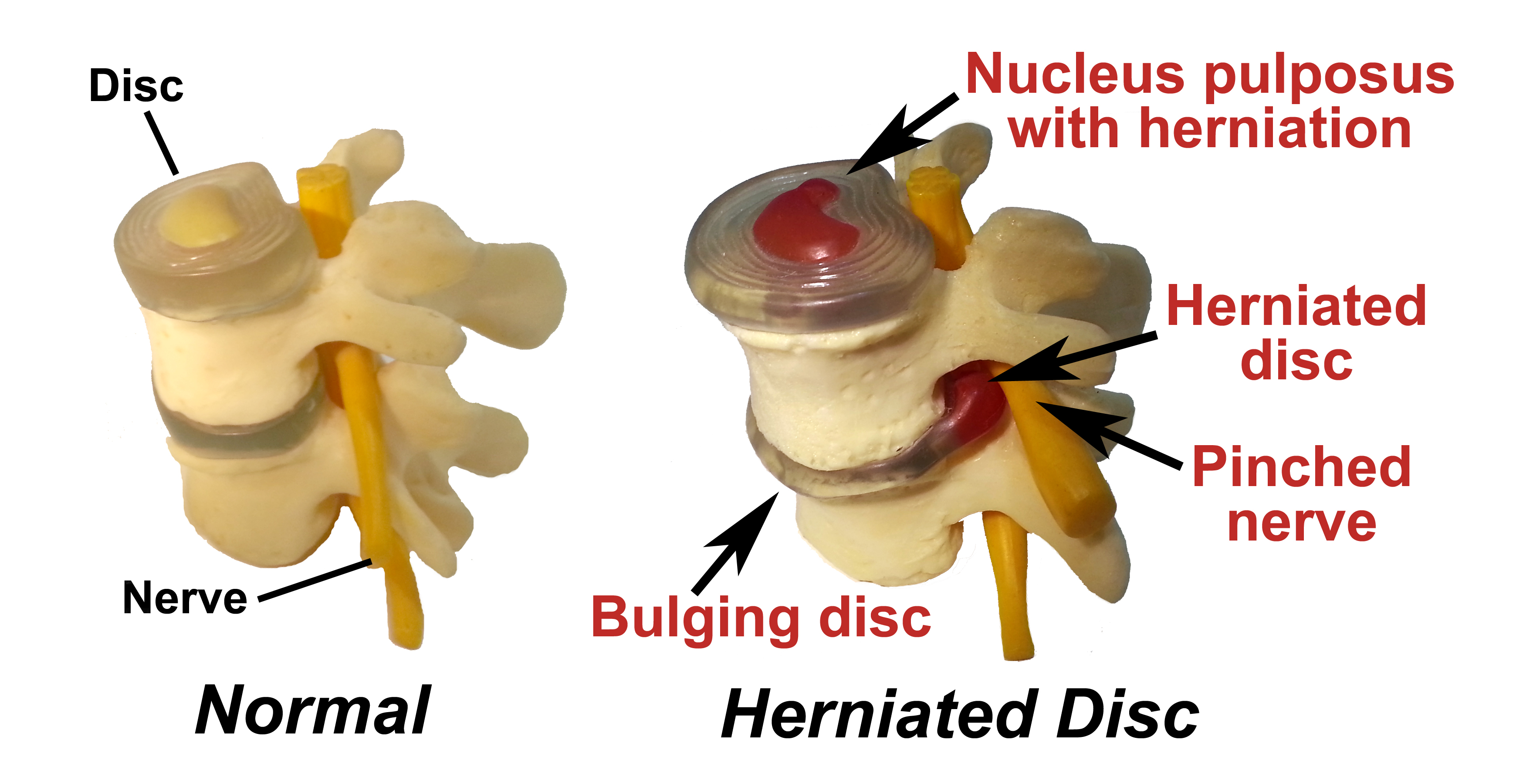 What Causes A Herniated Disk In Lower Back