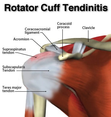 PART 1: SHOULDER SERIES - 5 MOST COMMON DIAGNOSIS -ROTATOR CUFF INJURIES - Back & Joint Rehab ...