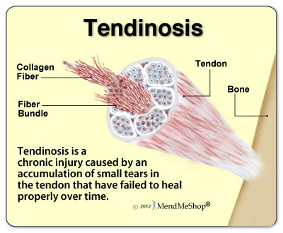 tendinosis-chronic-injury - Back & Joint Rehab Center Indiana