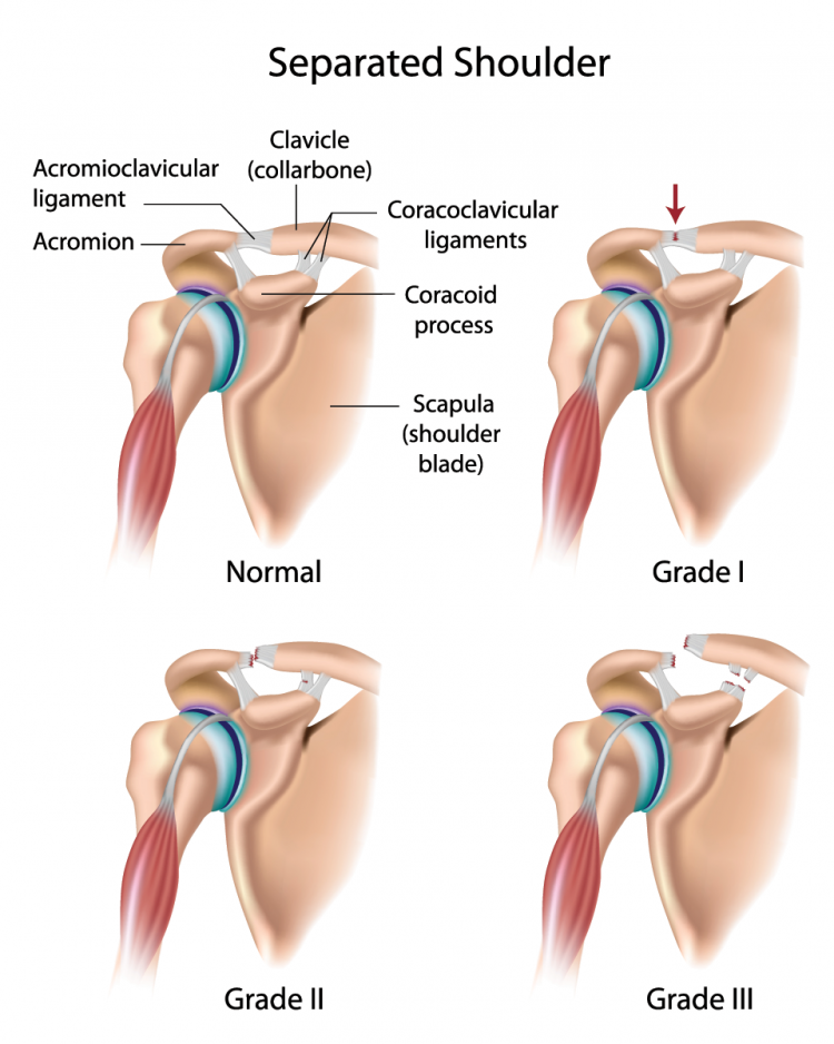 separated-shoulder-back-joint-rehab-center-crown-point-indiana