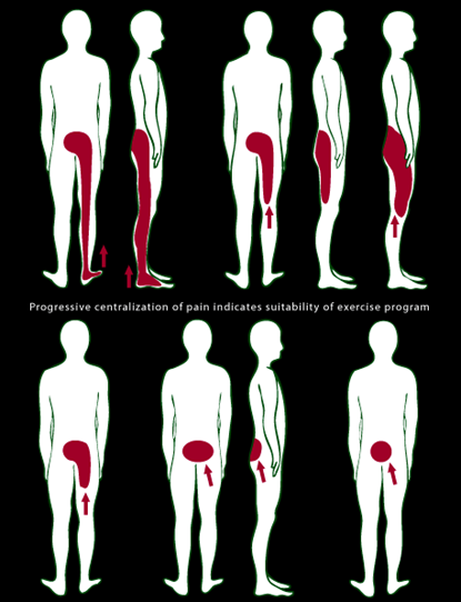 mckenzie exercises for sciatica