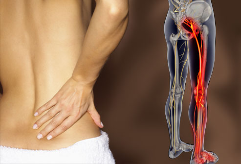 Sciatica, Lower Back Pain & the Sciatic Nerve