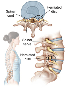 Herniated Disc Treatments