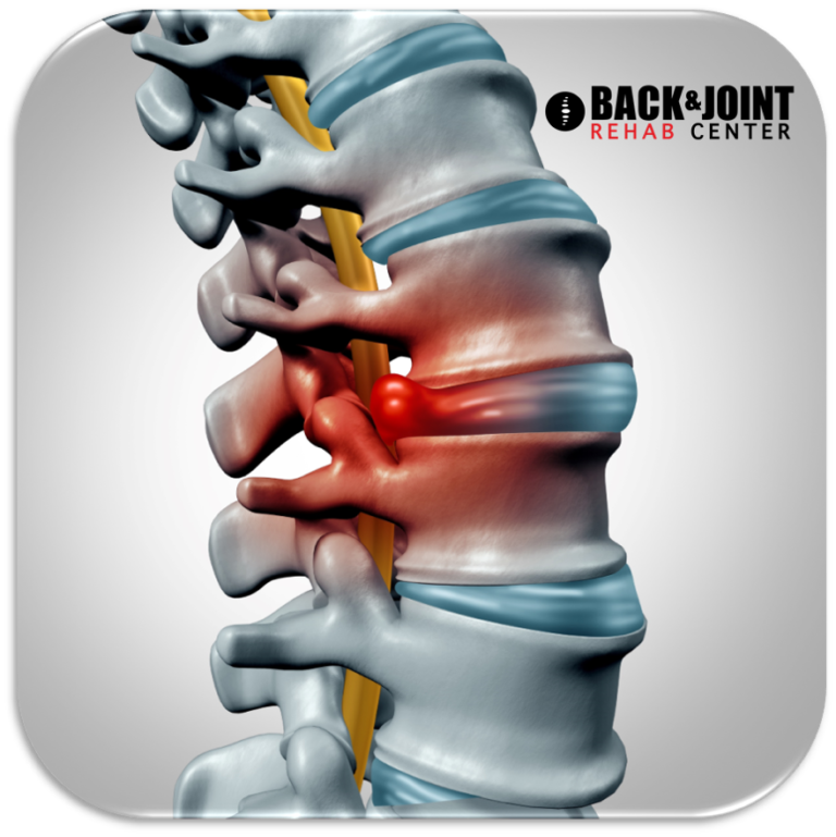 herniated disc, disc herniation, chiropractor, lower back pain, therapy ...
