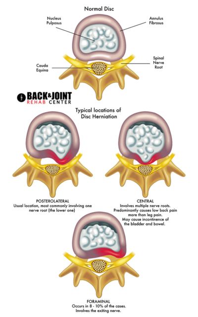 Herniated Disc, Disc Herniation, Chiropractor, Lower Back Pain, Therapy ...