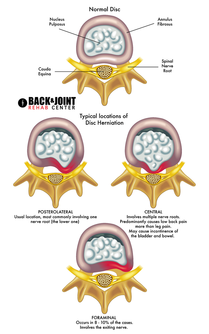 Central disc herniation treatment