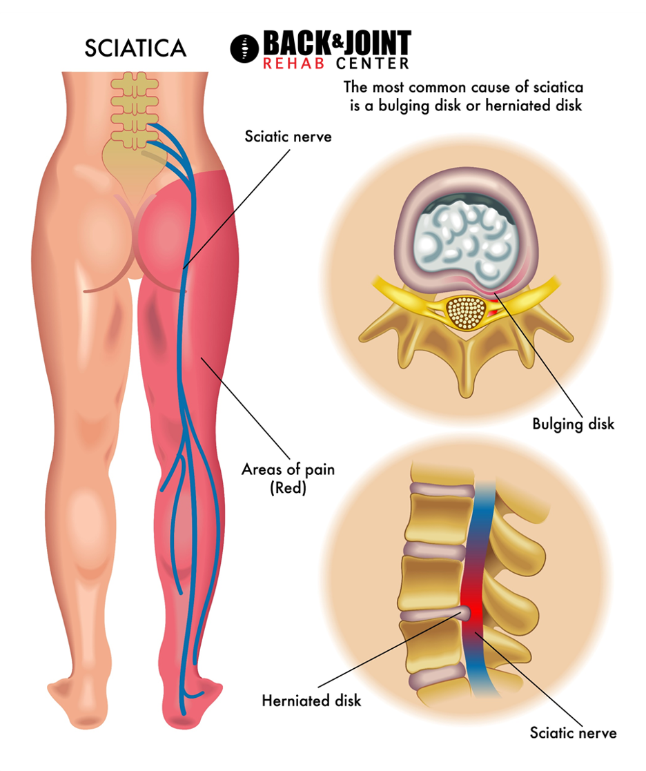 sciatica pain, sciatic nerve pain, sciatica, shooting leg pain
