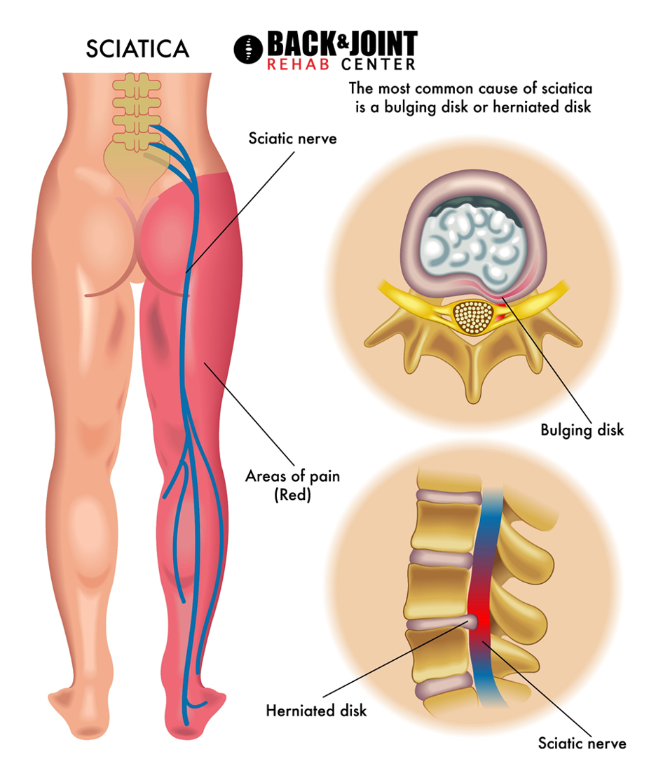 Sciatica: Signs & Symptoms - Back & Joint Rehab Center Crown Point Indiana